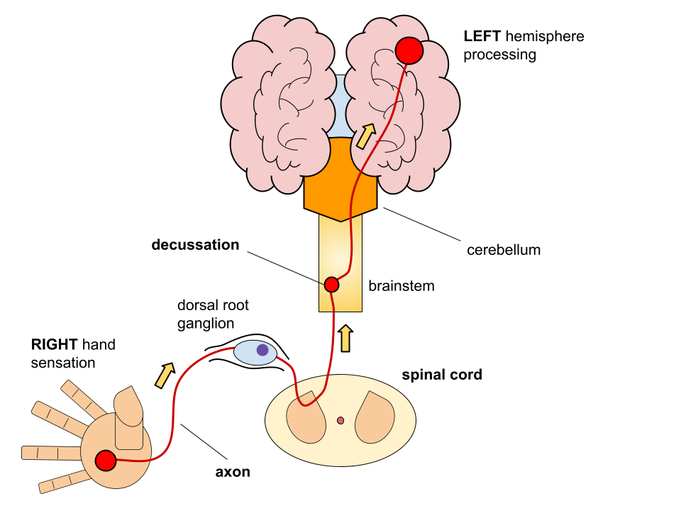 Figure 4. Decussation of a sensory nerve from the right side of the body to the left side of the brain. Sensory information travels up the nerve axon from the right hand, through the cell body in the dorsal root ganglion, and up the spinal cord en route to the brain. As the axon reaches the brainstem, it crosses over the midline of the spinal cord via decussation and heads to the contralateral side of the brain.